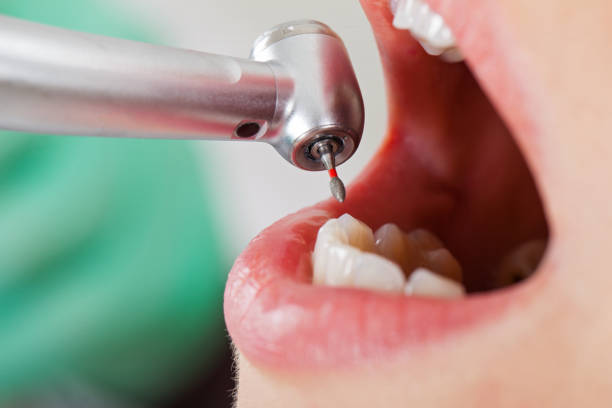 Best Broken or Cracked Tooth Emergency Dentist in Allyn, WA